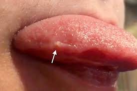 Image result for yellow tongue infection