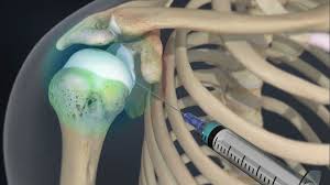 Image result for Shoulder Injection