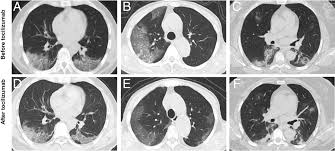 Maybe you would like to learn more about one of these? Effective Treatment Of Severe Covid 19 Patients With Tocilizumab Pnas