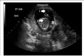 I also had to urinate constantly (twice a night in my sleep). Ultrasound Of Abdomen And Pelvis 1 Gestational Sac 2 Fetus Download Scientific Diagram