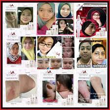 Sebulan pakai pun dah nampak kesan. Kesan Penggunaan Meeracle Gemstone Serum