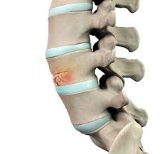 Image result for Vertebral Compression Fracture