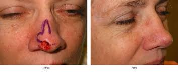 14.11.2019 · the patient had basal cell cancer on his nose which was removed via mohs' surgery. Pictures Of Skin Cancer Reconstruction