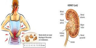Suffering From A Kidney Stone Take Steps Immediately