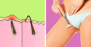 In general, ingrown hairs look like small red bumps on the skin that center on a hair follicle. How To Get Rid Of Ingrown Hair And Avoid Getting It