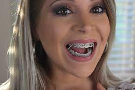They do so by spanning across the top and bottom arches. Adult Braces Update 8 Month 11 Expanders Elastics