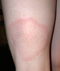 Pression dans la tête, lésions de la substance blanche dans le cerveau (irm). Maladie De Lyme Causes Symptomes Prise De Sang Et Traitement Du Lyme Mon Dermato En Visio