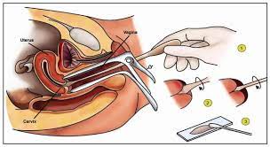 Saat melakukan pap smear atau iva, dokter akan memasukkan spekulum (alat dengan bentuk serupa. Penjelasan Soal Pap Smear Gratis Atau Berbayar Kumparan Com