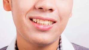 Selain tindakan dokter, terdapat beberapa cara untuk memutihkan gigi yang bisa dilakukan di rumah. Gigi Kuning Penyebab Ciri Ciri Cara Memutihkan Doktersehat