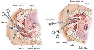 Culdocentesis Culdoscopy Zelda Characters Character Princess Zelda
