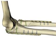 LCP Metaphyseal Plate 3.5, 4.5, and 5.0