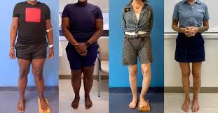 Image result for Functional Leg Length Discrepancy