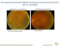 This means you may have had to wait longer than usual for your routine diabetic eye screening appointment. Drushti Eye And Retina Center One Eyed With Advanced Diabetic Eye Disease With Good Pre Op Vision 20ref No 0600562