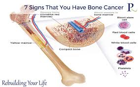 How do people know they have cancer? Read About 7 Signs That You Have Bone Cancer