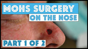 Mohs surgery is a commonly performed procedure that involves removing cancer from the skin. Mohs Surgery On The Nose Part 1 Of 2 Taking Mohs Layers Youtube
