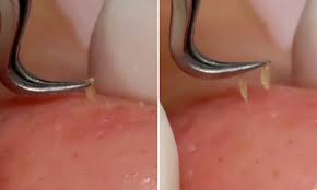Taiwan Beautician Drags Yellow Strands Of Oil Out Of Woman S Pores To Improve Complexion Daily Mail Online