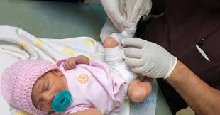 Image result for Clubfoot