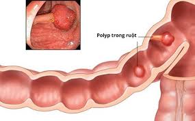 Tuy nhiên cần lưu ý những điều sau: Polyp Trá»±c Trang La Gi Táº¡i Sao Cáº§n Cáº¯t Polyp Trá»±c Trang