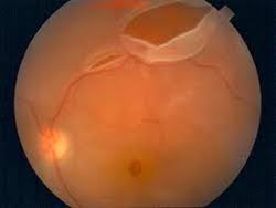 Ophthalmologists occasionally perform cryotherapy if the location of the tear makes it difficult to perform laser photocoagulation. Retinal Tears And Retinal Detachment Lang Eye Centre