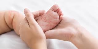 Vicks inhaler adalah inhalasi untuk melegakan hidung tersumb. Pakar Kesehatan Anak Kenalkan Alergen Untuk Ketahui Alergi Pada Bayi
