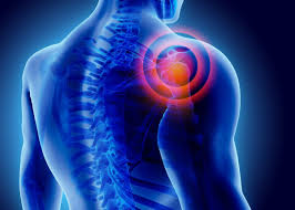 Educational image placeholder: shoulder pain with overhead movement
