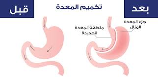 عملية تكميم المعدة التكلفة والأضرار وصور قبل وبعد للنتائج تركي ويز