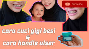 Bagi banyak orang, berkumur dengan air garam dapat digunakan sebagai salah satu cara pengobatan sakit gigi yang efektif. Damon Braces Part 1 Step Sebelum Doc Pasang Braces Youtube