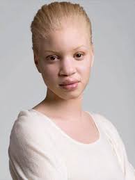 Albinism Is Beautiful Albinism Whiter Skin Black Is Beautiful