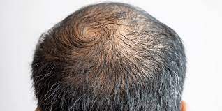 While making changes it's often better to assess how much hair loss you have, instead of how fast your hair is growing back. Can My Hair Grow Back After Thinning Njhrc Blog