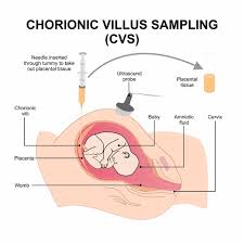 Image result for Chorionic Villus Sampling