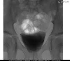 The clinical significance of vur has been based on. Medpix Case Idiopathic Vesicoureteral Reflux Grade 2 3 Reflux On The Right And Grade 1 On The Left See Factoid
