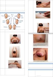 Grátis: Câncer de mama - Material Claro e Objetivo em PDF para Estudo Rápido