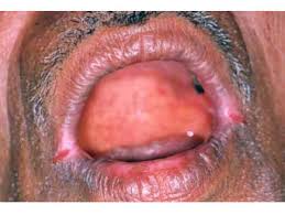 Image result for Angular Cheilitis