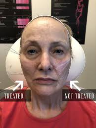 We did not find results for: Pdo Thread Treatments Non Surgical Facelift Spa Trouve In Utah