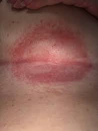 Image result for Candidiasis under breasts