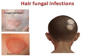 Image result for Tinea Capitis