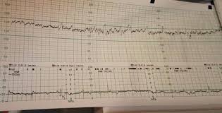 Hallo, ich habe mal eine frage und zwar wenn man am ctg ist ja und die zeichnem ja die kontraktionen auf. Ctg August 2015 Babyclub Seite 12 Babycenter