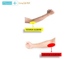 The wrist flexors and finger flexors become much stronger than the wrist extensors. Physio Plus Why Is The Inner Part Of My Elbow Painful Why Is The Outer Part Of My Elbow Painful Pain On Either Side Of Elbow Has Specific