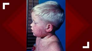 Everything you need to know about the measles