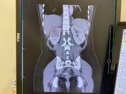 憋尿傷腎！醫提醒這8類人為好發族群- 17news民生好報