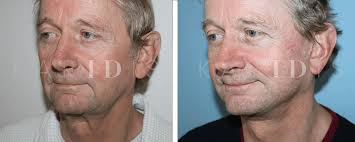 We did not find results for: Mid Face Lift Before And After Photos Uk Karidis