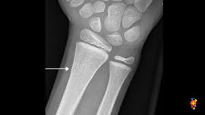Image result for Wrist XRay