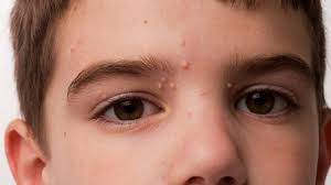 If you have skin cancer, it is important to know which type you have because it affects your treatment options and your outlook (prognosis). Molluscum Contagiosum Causes Symptoms Treatment And Pictures