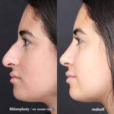 This is especially important when it comes to restoring the overall balance and symmetry of your face. 64 Rhinoplasty Nose Jobs Ideas In 2021 Nose Job Rhinoplasty Nose Jobs Rhinoplasty