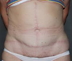Check out results for pictures tummy tuck Massive Weightloss Fleur De Lis Tummy Tuck Harley Plastic Surgery