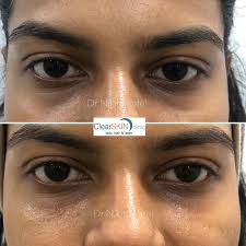 Under eye filler is a great way to look more rested & reduce the under eye  hollows. We have used 1 syringe of Hyaluronic acid (1ml) in this case.  Results are expected