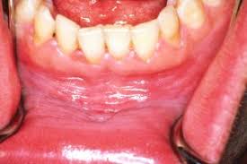 A swelling on the gum can be treated depending on the kind of infection causing the boil. Gum Boils What They Are What Causes Them What To Do About Them
