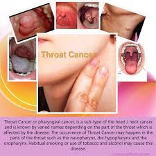 Throat cancer is a type of oral cavity and pharynx cancer. Throat Cancer Please Visit At Link To Read More About By Hawn Bingham Medium