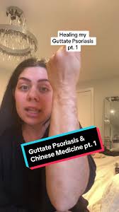 Pt. 1 of my Chinese Medicine journey to heal my Guttate Psoriasis of 10+  years! #psoriasis #psoriasisawareness #guttatepsoriasis #psoriasiswarrior  #chinesemedicine #holistichealth #holistichealing