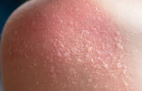 Image result for Sunburn